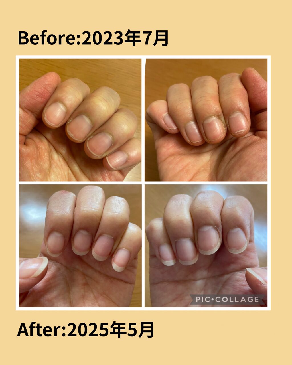 二枚爪ビフォーアフター Before:2023年7月 After:2025年5月